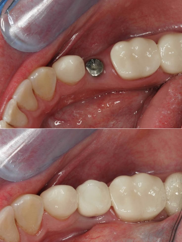 Complete dental restoration - before and after comparison