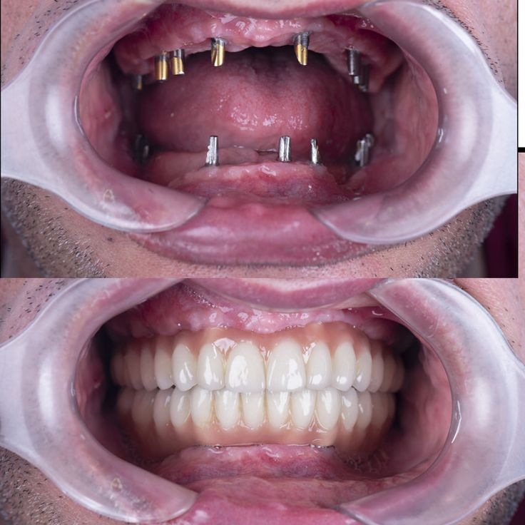 Dental implant transformation - before and after results